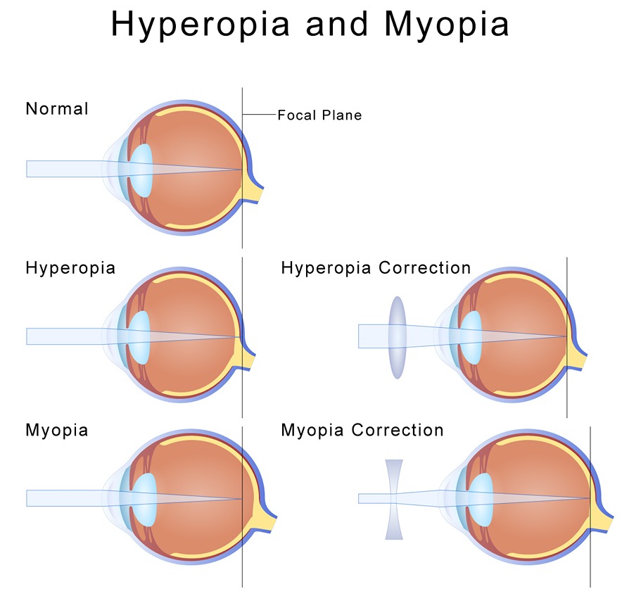correcting myopia